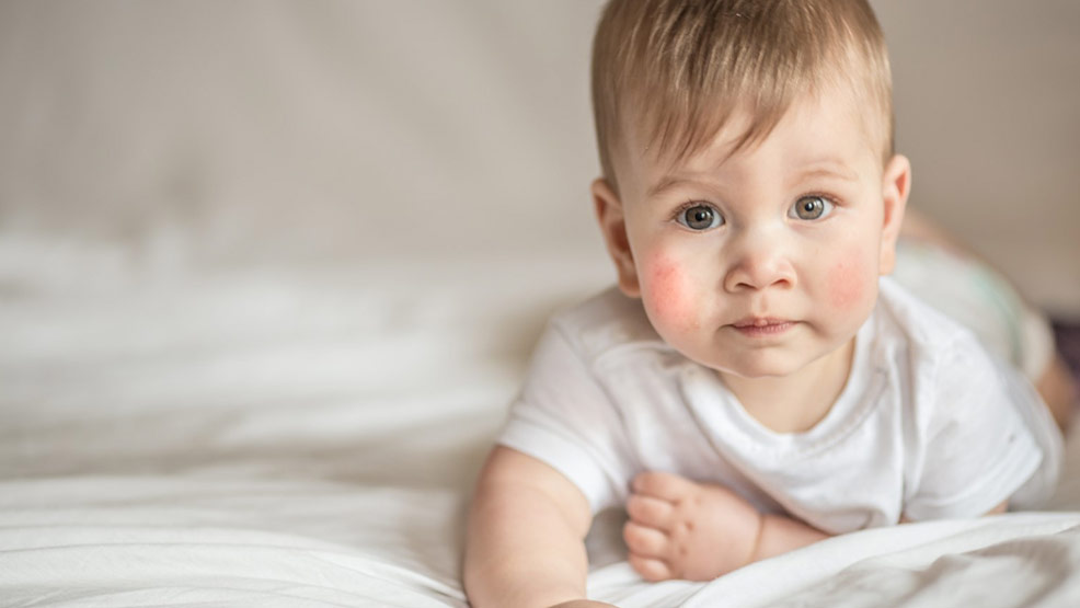 Łojotokowe zapalenie skóry - jak nie pomylić atopowego zapalenia skóry z innymi chorobami? - Zdjęcie główne