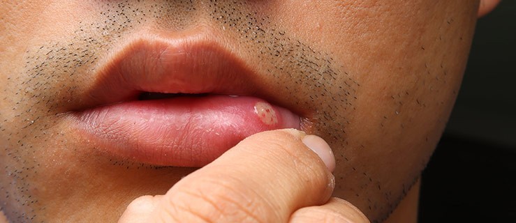 Pleśniawki - skuteczne sposoby w walce z infekcją w jamie ustnej - Zdjęcie główne