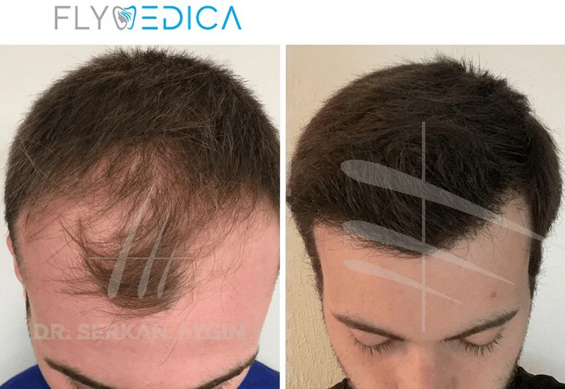 FlyMedica - lider w turystyce medycznej związanej z przeszczepem włosów w Turcji - Zdjęcie główne