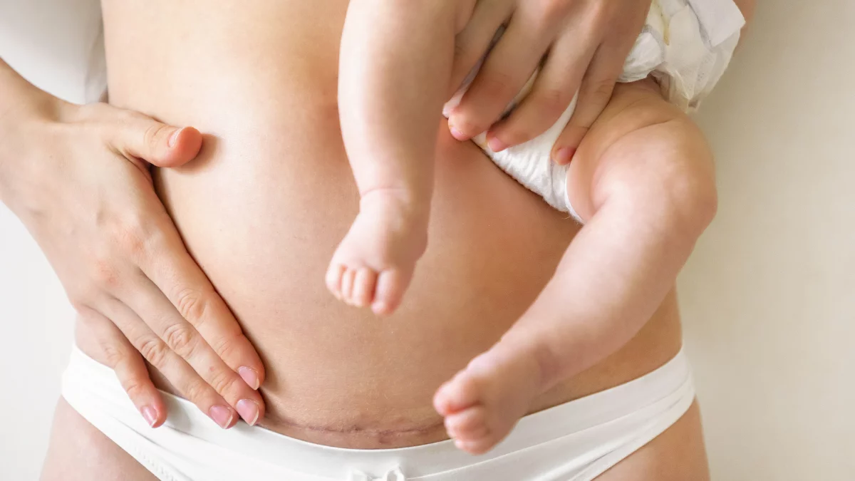 Blizna po cesarskim cięciu - dlaczego może powodować problemy i jak można ją leczyć? Trwa nabór do badania