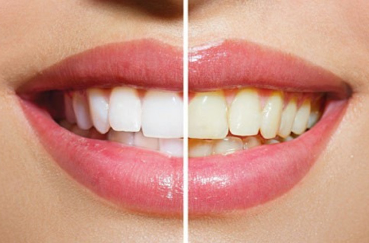 Sekret Ajurwedy! Nowy uśmiech w 2 tygodnie! - Zdjęcie główne