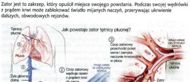 Zatory są groźne - Zdjęcie główne